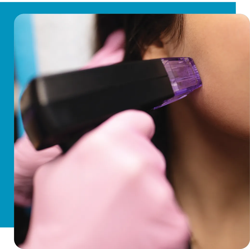 Morpheus 8 Treatment 3