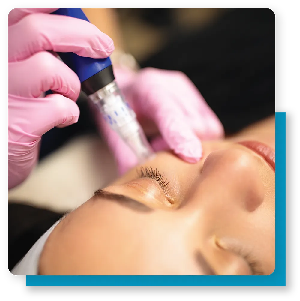 micro-needling benefits
