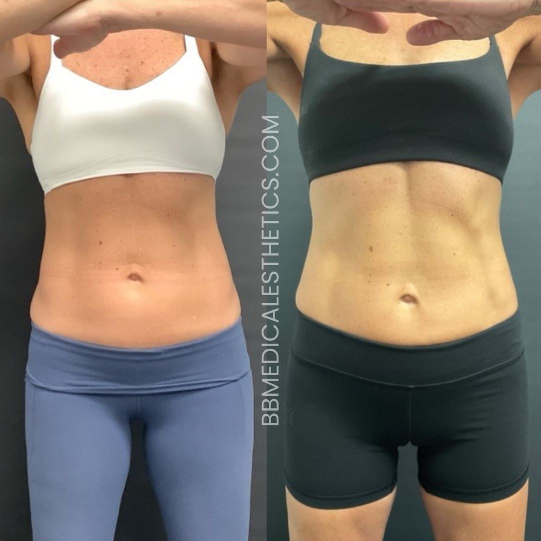 CoolTone Before and After