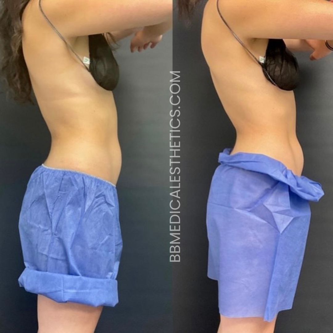 CoolTone Before and After(1)