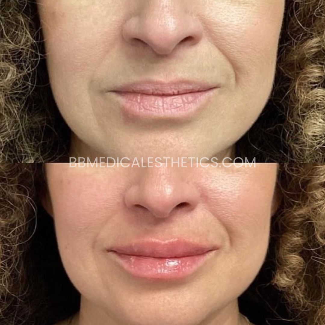 Lip Filler Before and After