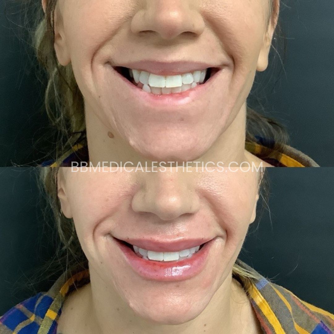Lip Filler Before and After(1)