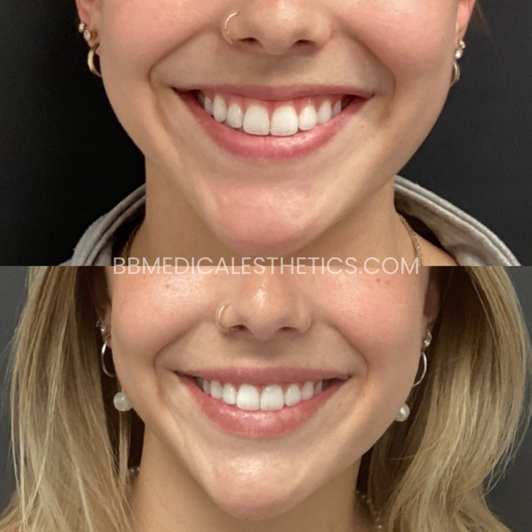 Lip Filler Before and After(2)