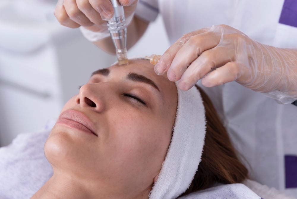 Close,Up,Of,Cosmetologist,beautician,Applying,Facial,Dermapen,Treatment,On,Face How to Prepare for a Microneedling Appointment Near Meridian, Idaho (And What to Expect)