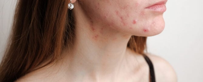 Best Acne Specialist in Boise, Idaho: How to Finally Get the Clear Skin You Deserve