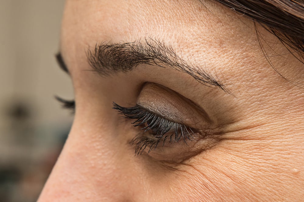 Botox for Crow's Feet