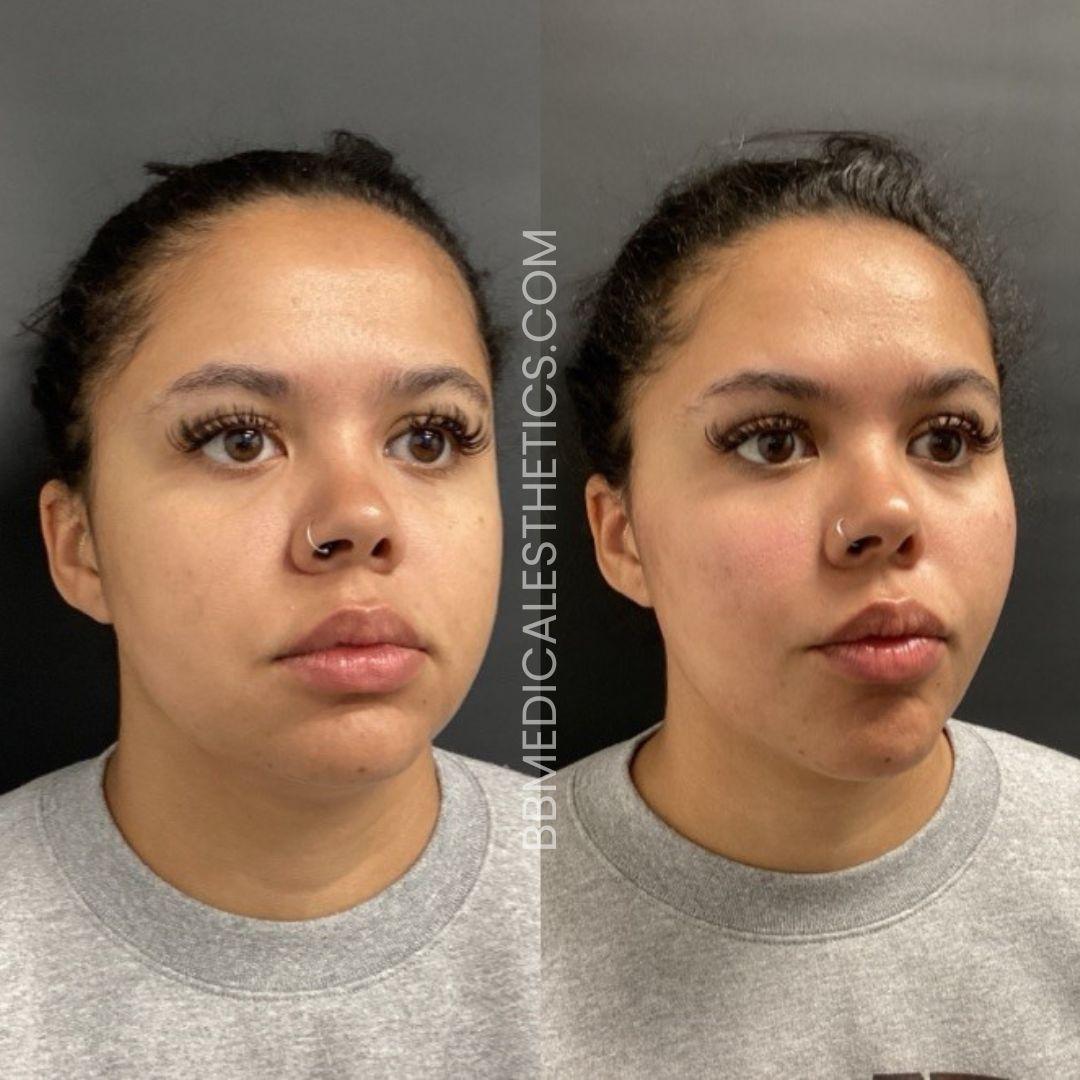 Cheek Filler Before and After_